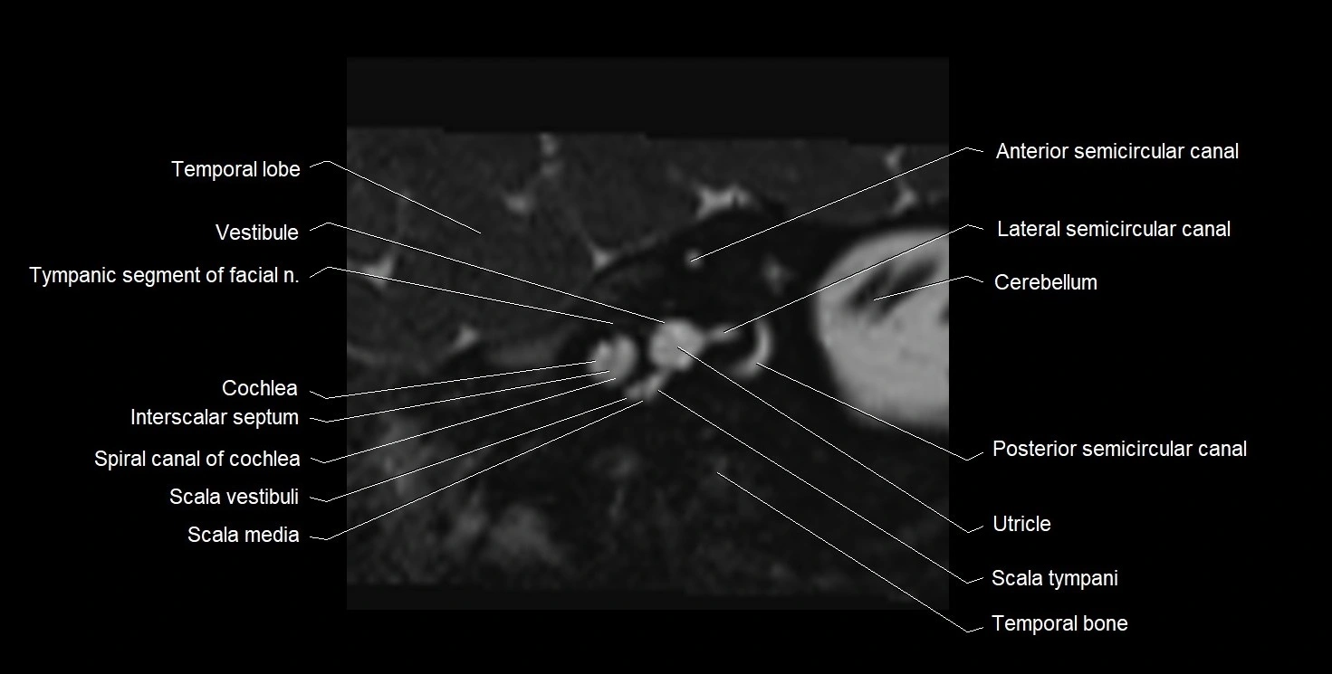 Internal auditory meatus (IAM) 3T sagittal cross sectional anatomy image 8.webp